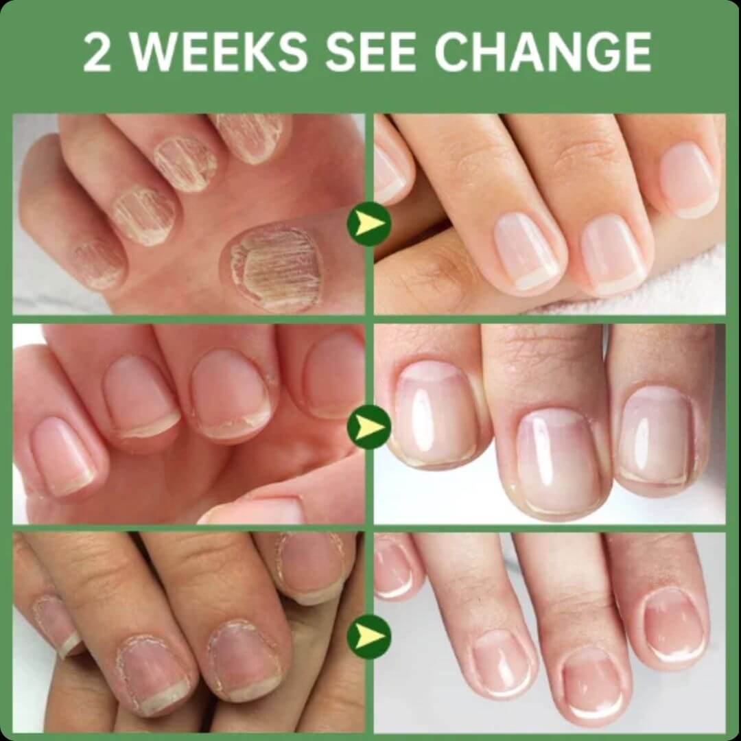 NailRevita Pro™ -Fortaleza y Crecimiento Superior para Tus Uñas