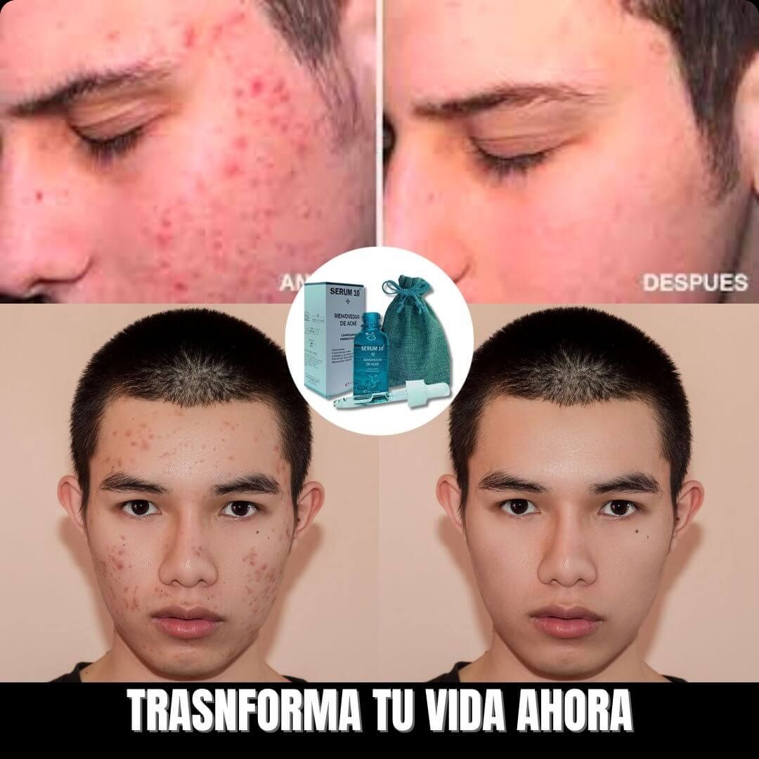 SERUM 10 ANTIACNÉ -🎁  PAGA 1 Y LLEVA 2